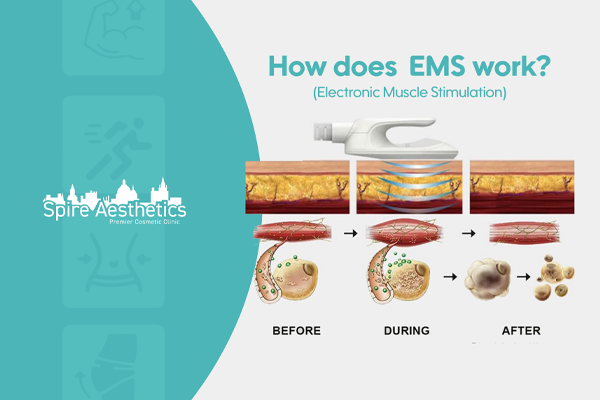 EMS treatment for post pregnancy weight loss treatment Thame