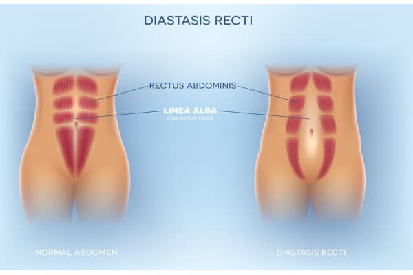 What Non-Surgical Options Are Available for Diastasis Recti Thame?