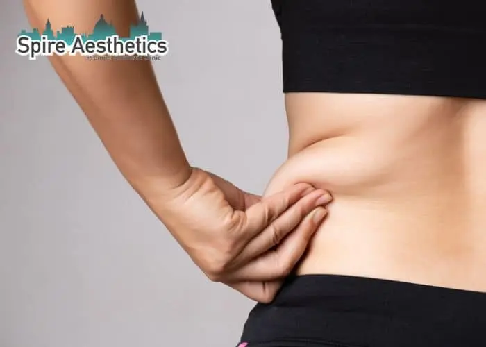 Image of woman pinching fat on their hips Thame. Fat Freezing treatment 