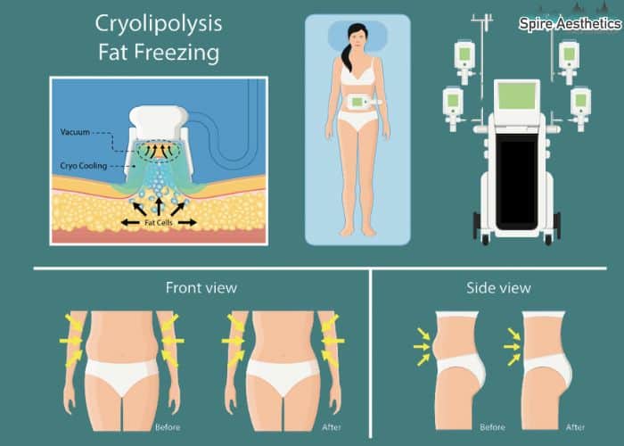 Image of diet and fat freezing combined for best results for Spire Aesthetics Thame