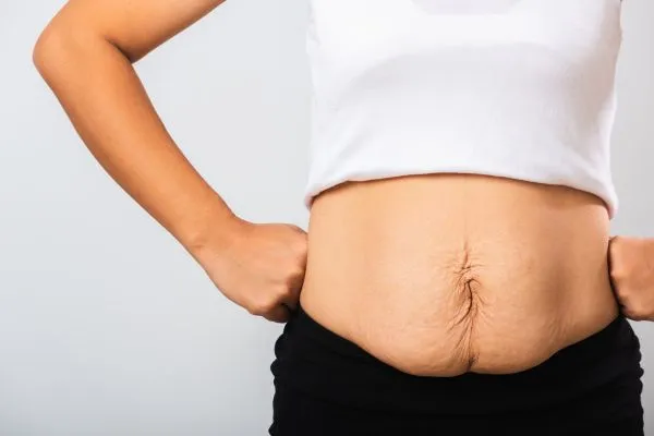 Image of a woman's stomach after weight loss with sagging skin following a gastric band Thame