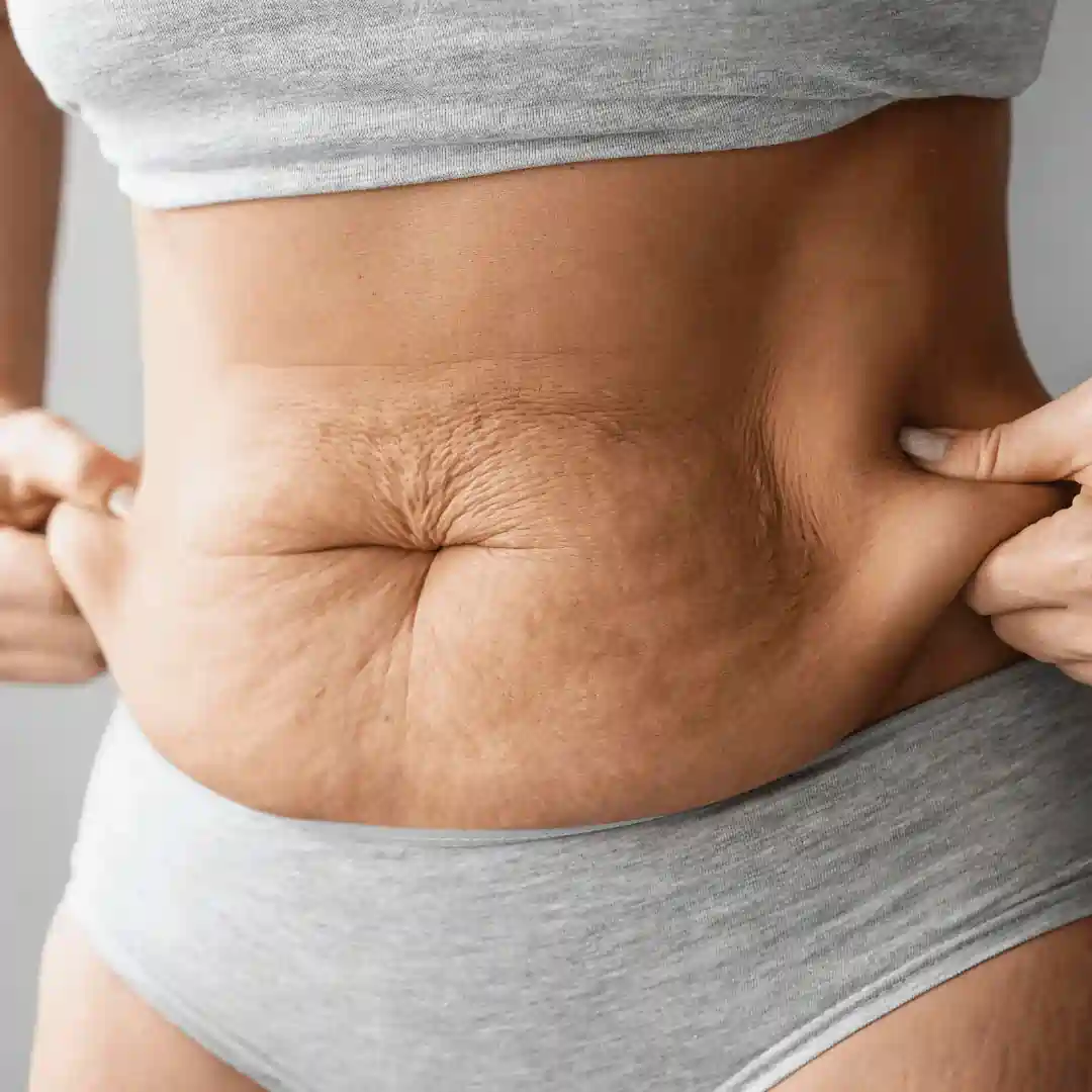 Is It Normal to Have Loose Skin After Pregnancy Thame?