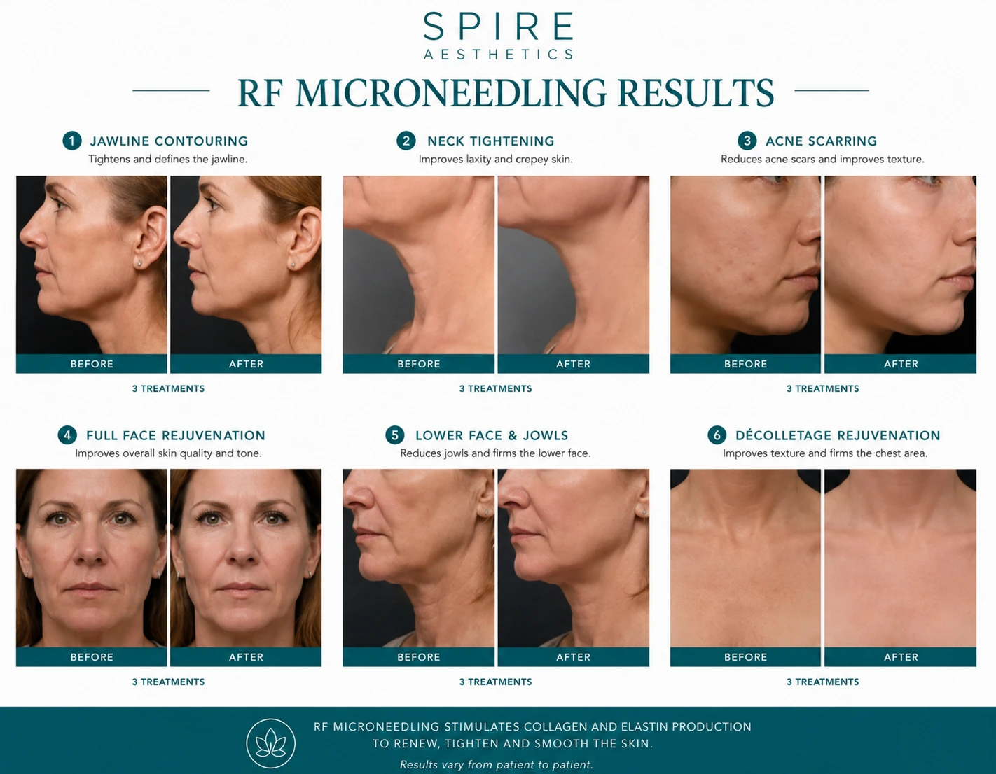 RF Microneedling Skin tightening Thame results