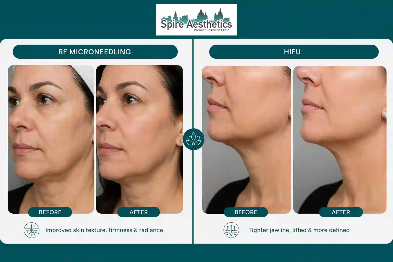 Can RF Microneedling and HIFU Be Combined Thame?