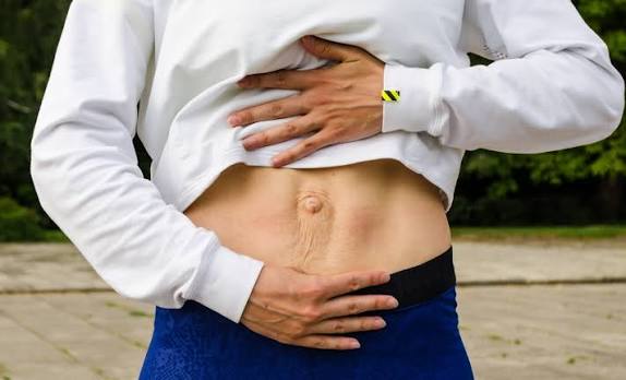 When Could Diastasis Recti Be the Missing Piece of the Puzzle Thame?