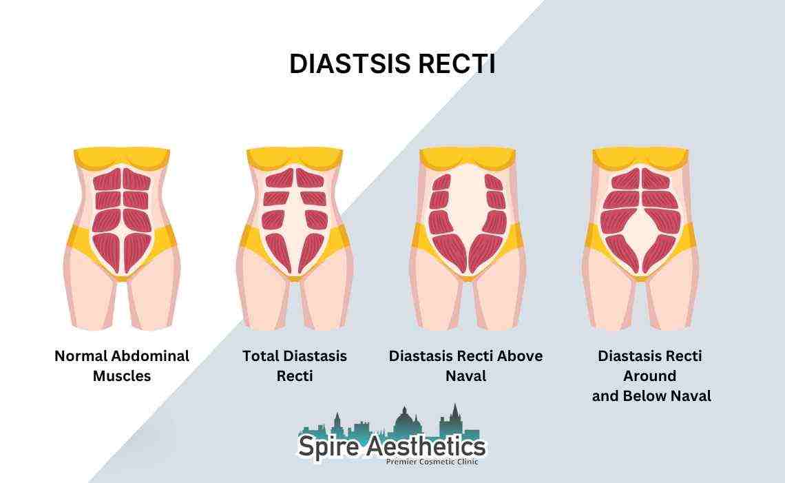 Is Non-Surgical Diastasis Recti Treatment Right for You? Common Concerns Answered Thame